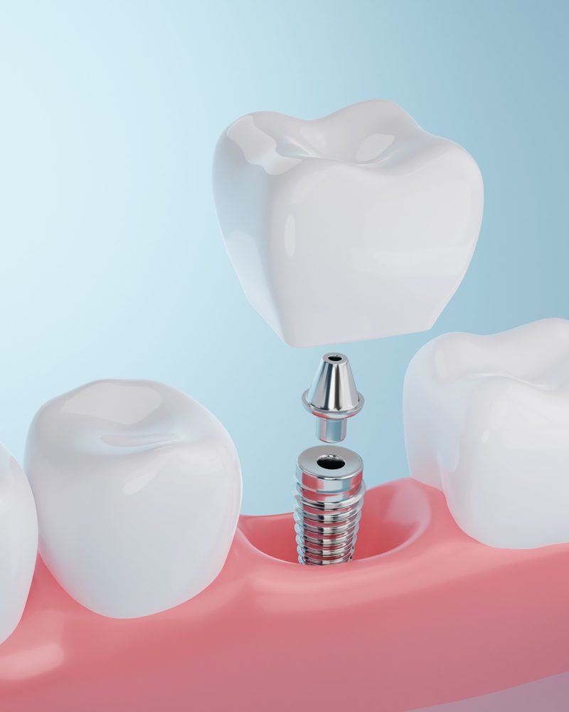 Dental implants in Zephyrhills, FL