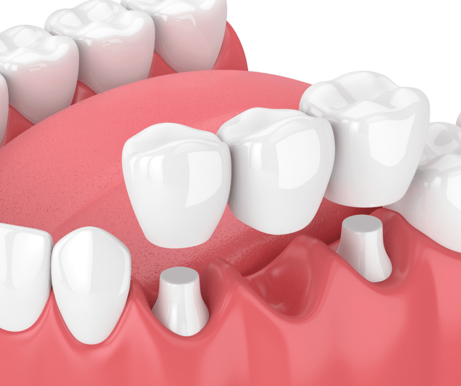 Dental Bridges - Zephyrhills, FL