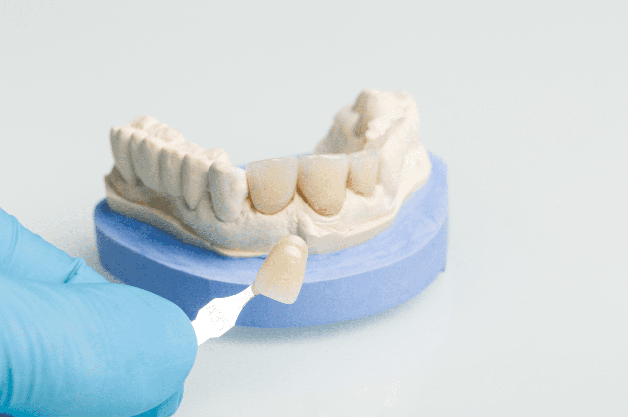 The Complete Guide to Dental Crowns Types, Procedures, and Aftercare